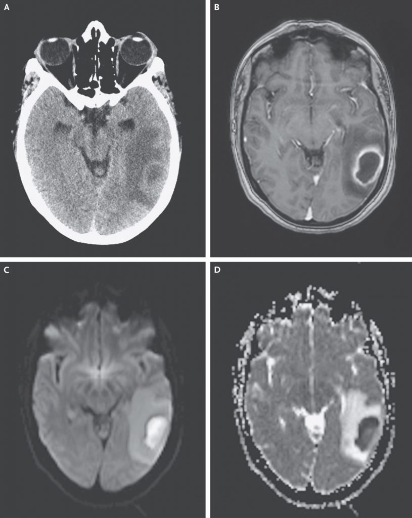 NEJM 2014より抜粋