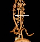 ic-stenosis ic-stenosis