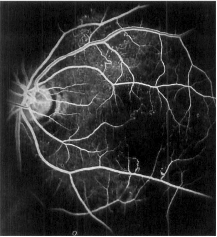 retinopathyrcvl1