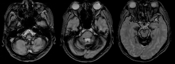 t2siderosis t2siderosis