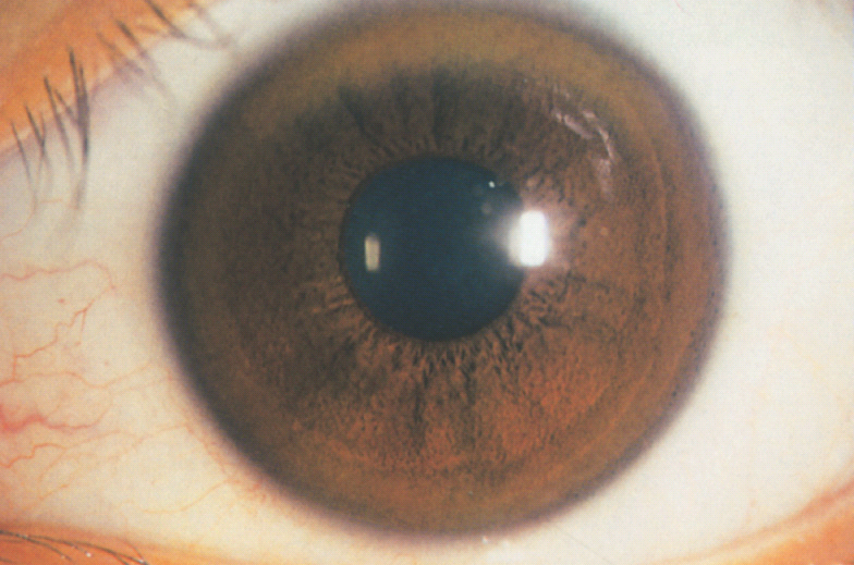 wilsoneye wilsoneye